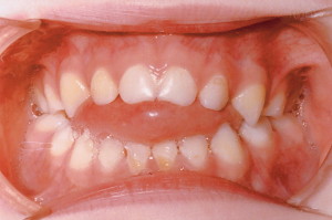 Anterior Open Bite