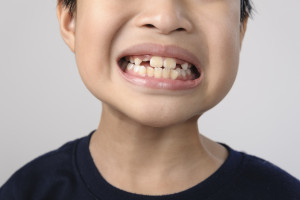 PDAS Baby Teeth